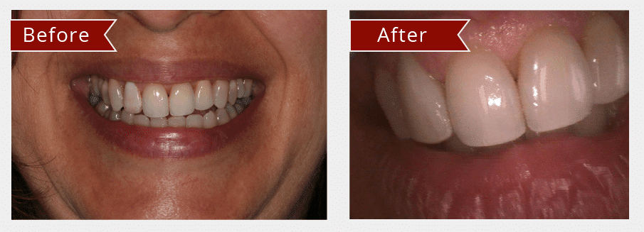 Before and After Image: Veneers - front