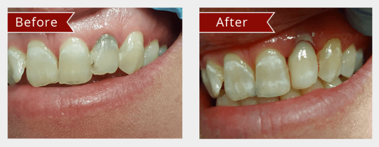 Before and After Image: Veneers - left-front-oblique