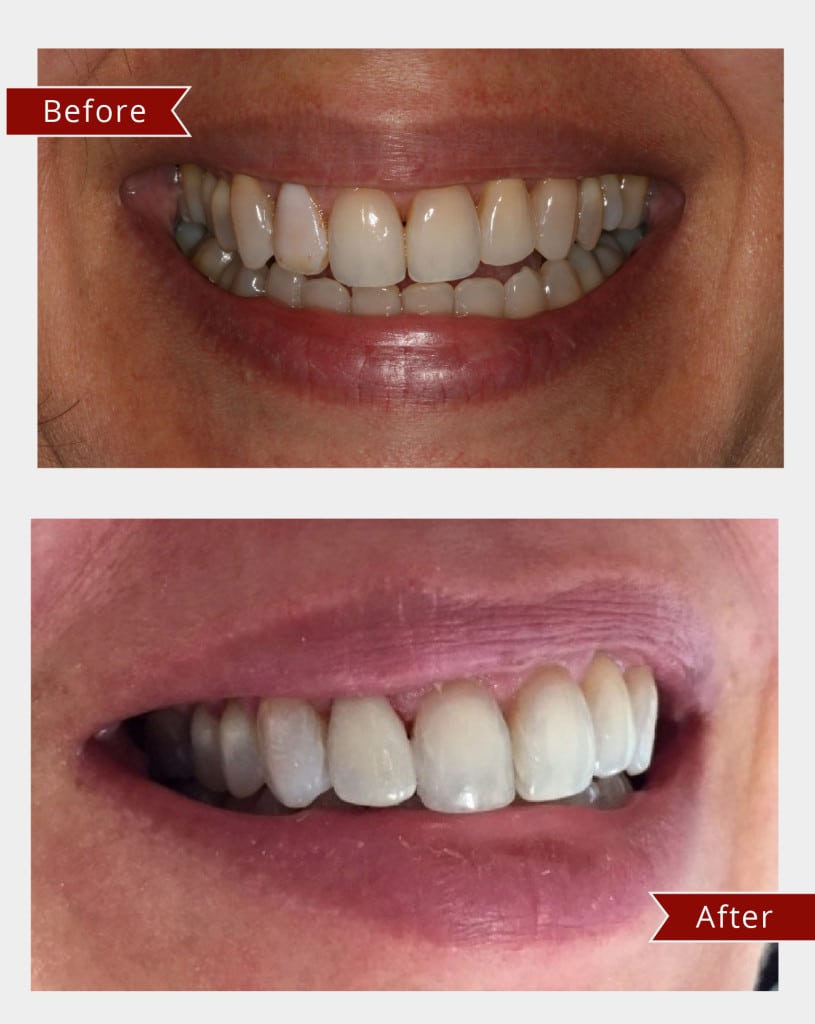 Before and After Image: Veneers - other