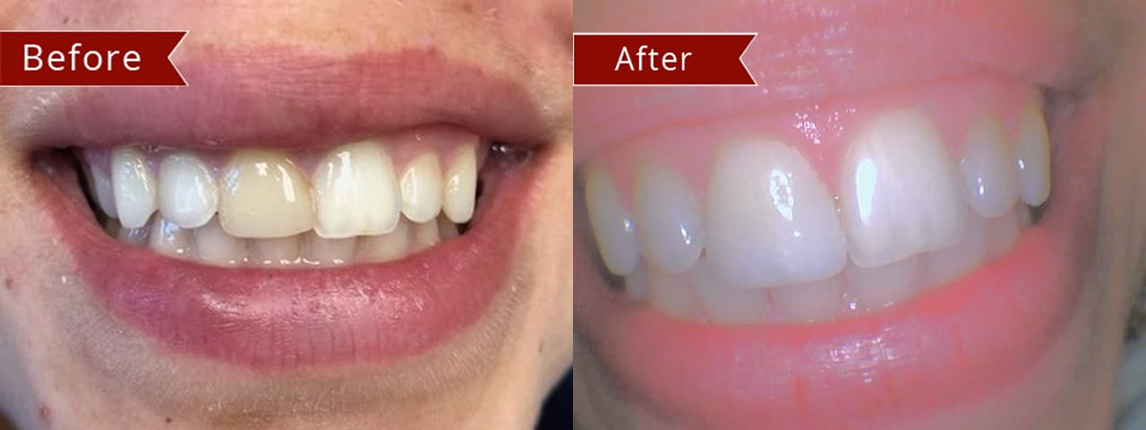 Before and After Image: Veneers - front