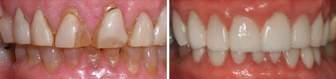 Before and After Image: Veneers - front
