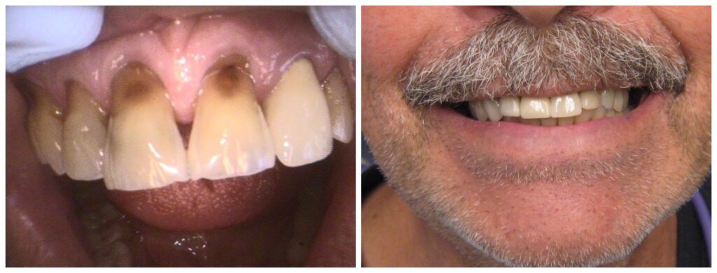 Before and After Image: Crowns - front