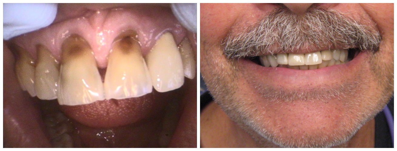 Before and After Image: Crowns - front