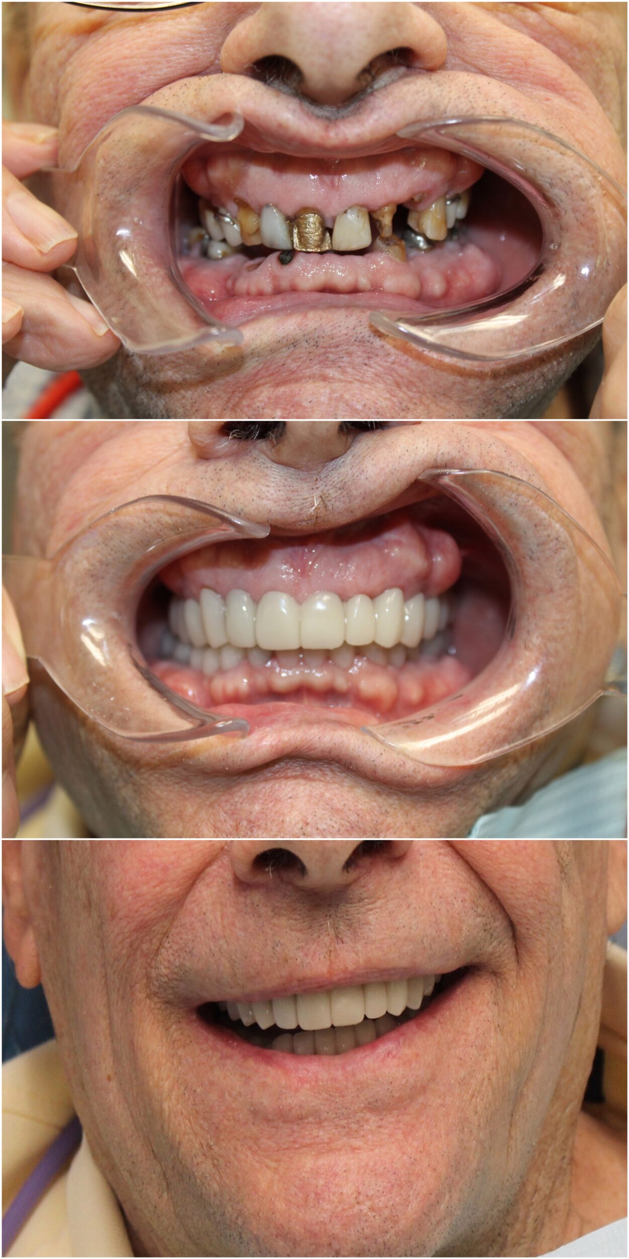 Before and After Image: Snap On Smile - front