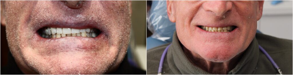 Before and After Image: Crowns - front