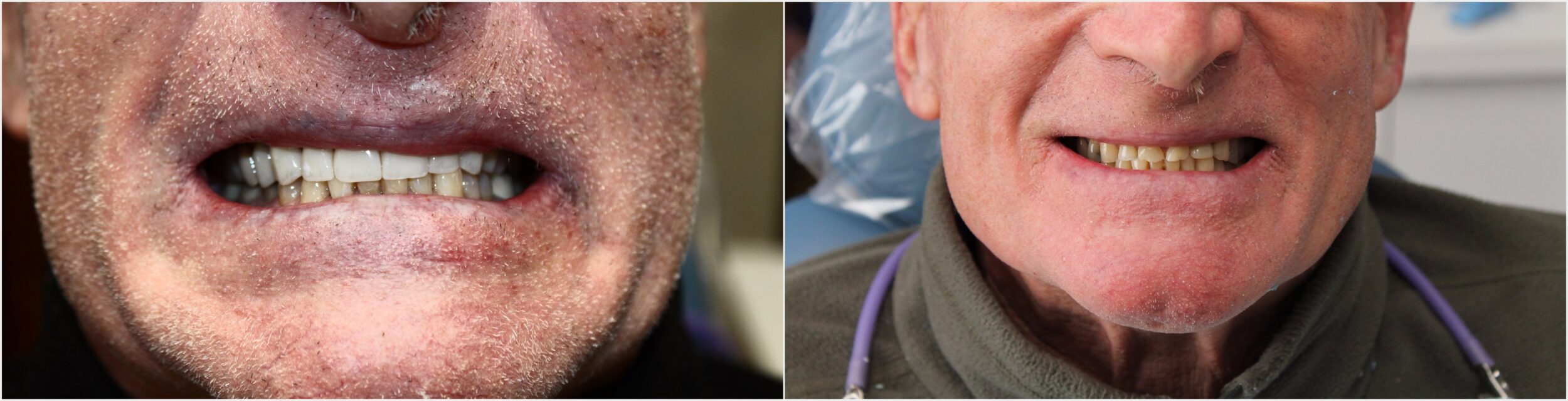 Before and After Image: Crowns - front