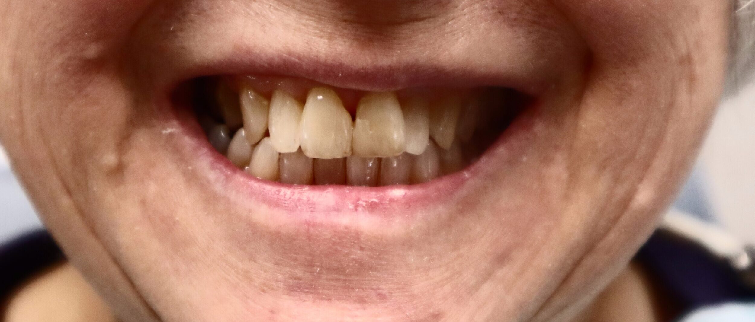 Before Image: Lumineers - front