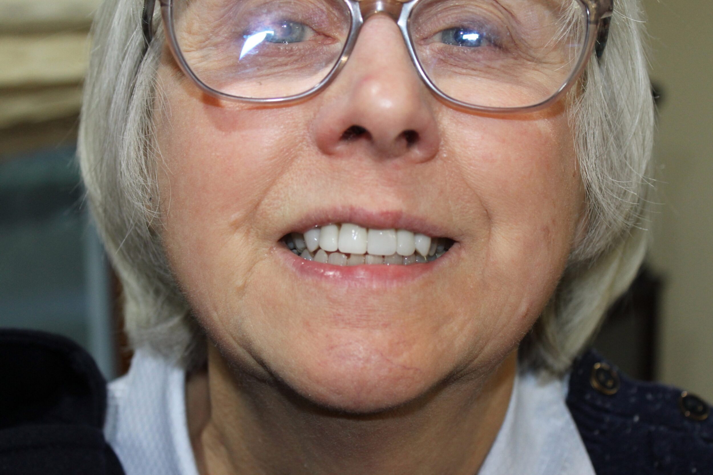 Before and After Image: Lumineers - front