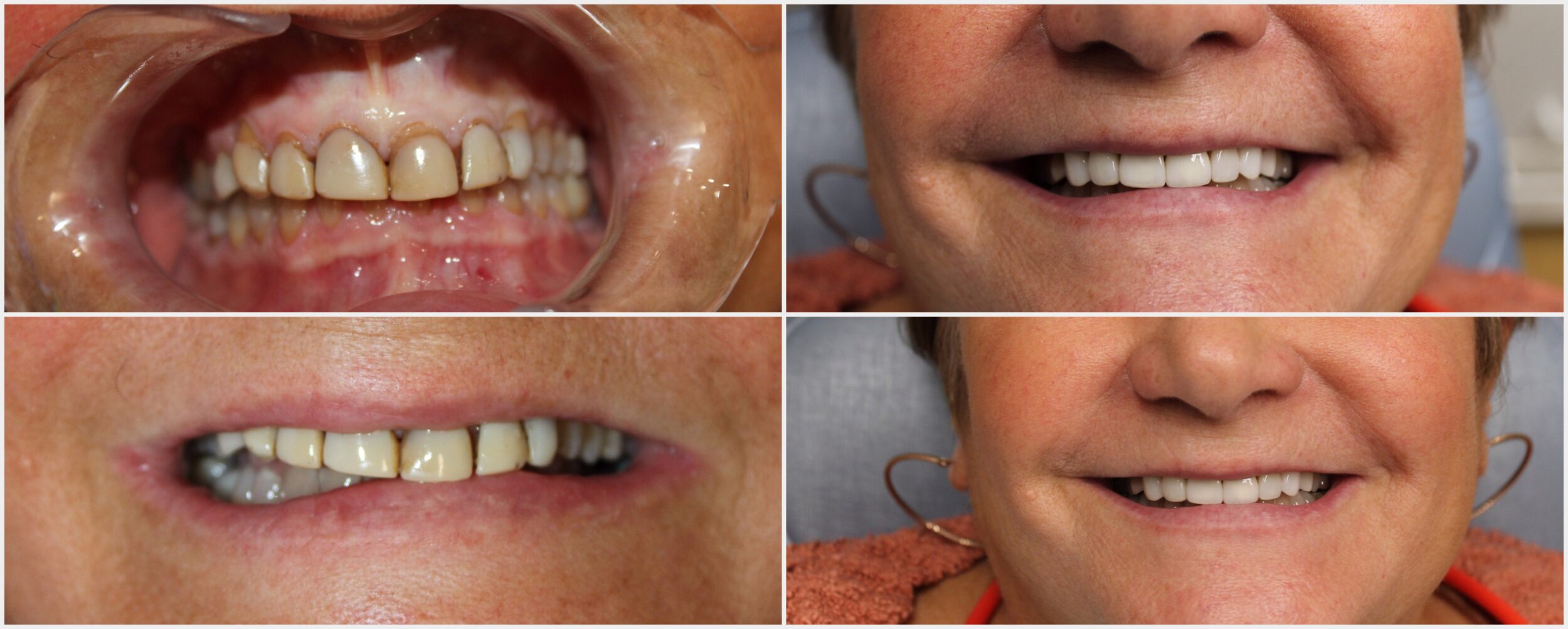 Before and After Image: Lumineers - front