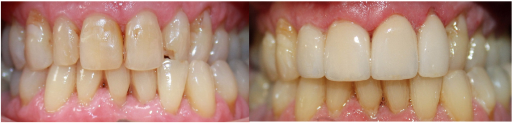 Before and After Image: Crowns - front