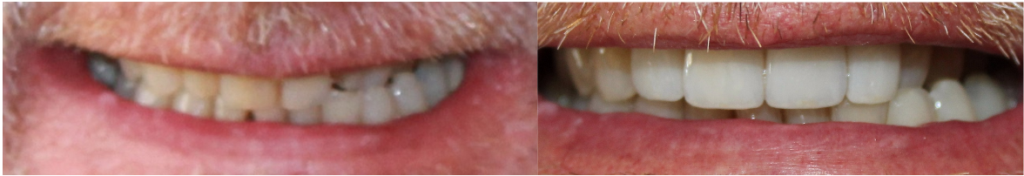 Before and After Image: Crowns - front