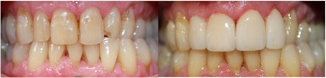 Before and After Image: Crowns - front