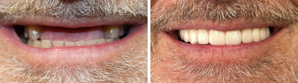 Before and After Image: All-on-4 - front