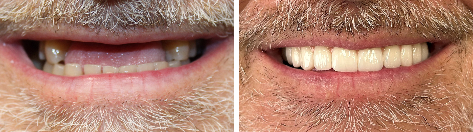 Before and After Image: All-on-4 - front