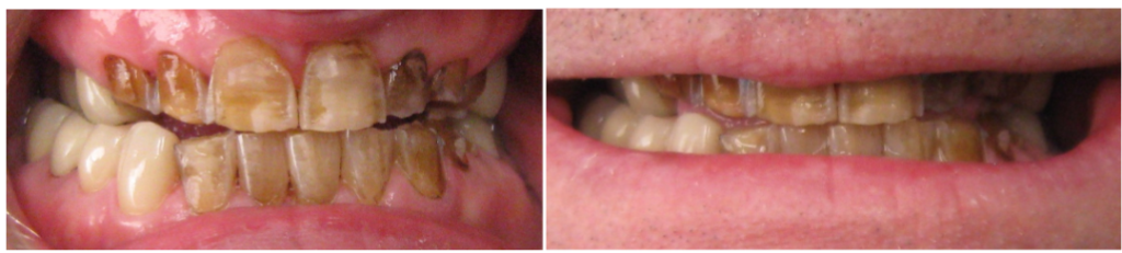 Before and After Image: Crowns and Veneers - front