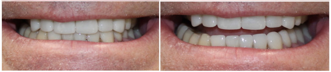 Before and After Image: Crowns and Veneers - front