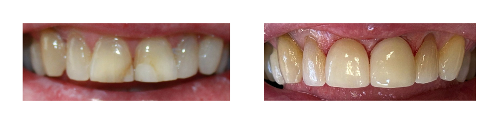 Before and After Image: Crowns - front