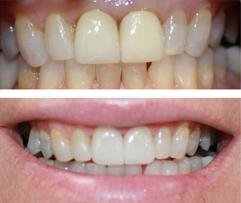 Before and After Image: Crowns - front