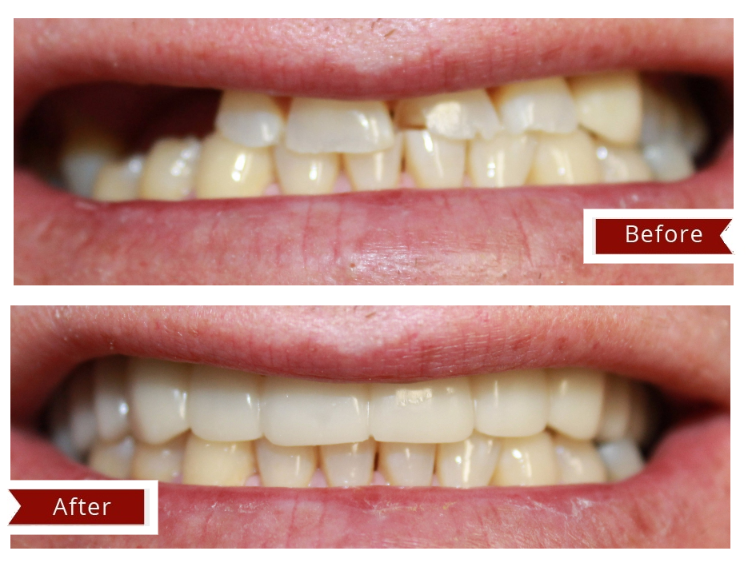 Before and After Image: Snap On Smile - front